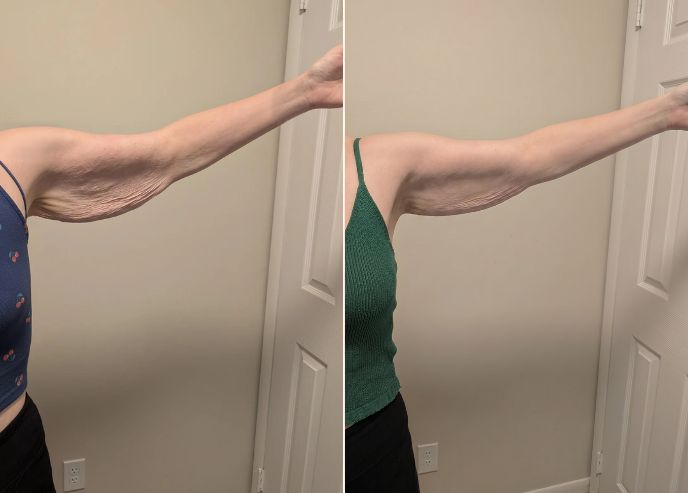 Arms before and after Vesper treatment