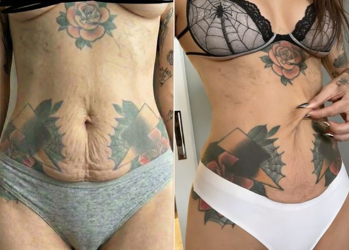 Before and after — Renee T.
