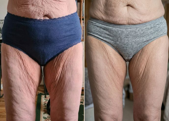 Helene K., before / after 12 weeks