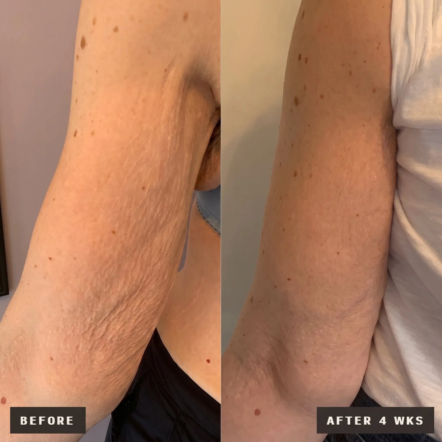 arms skin transformation in 4 weeks